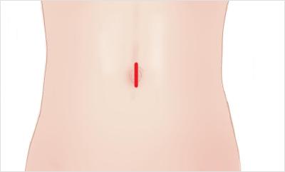 腹腔鏡手術の説明画像